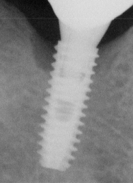 Track your Implants here!